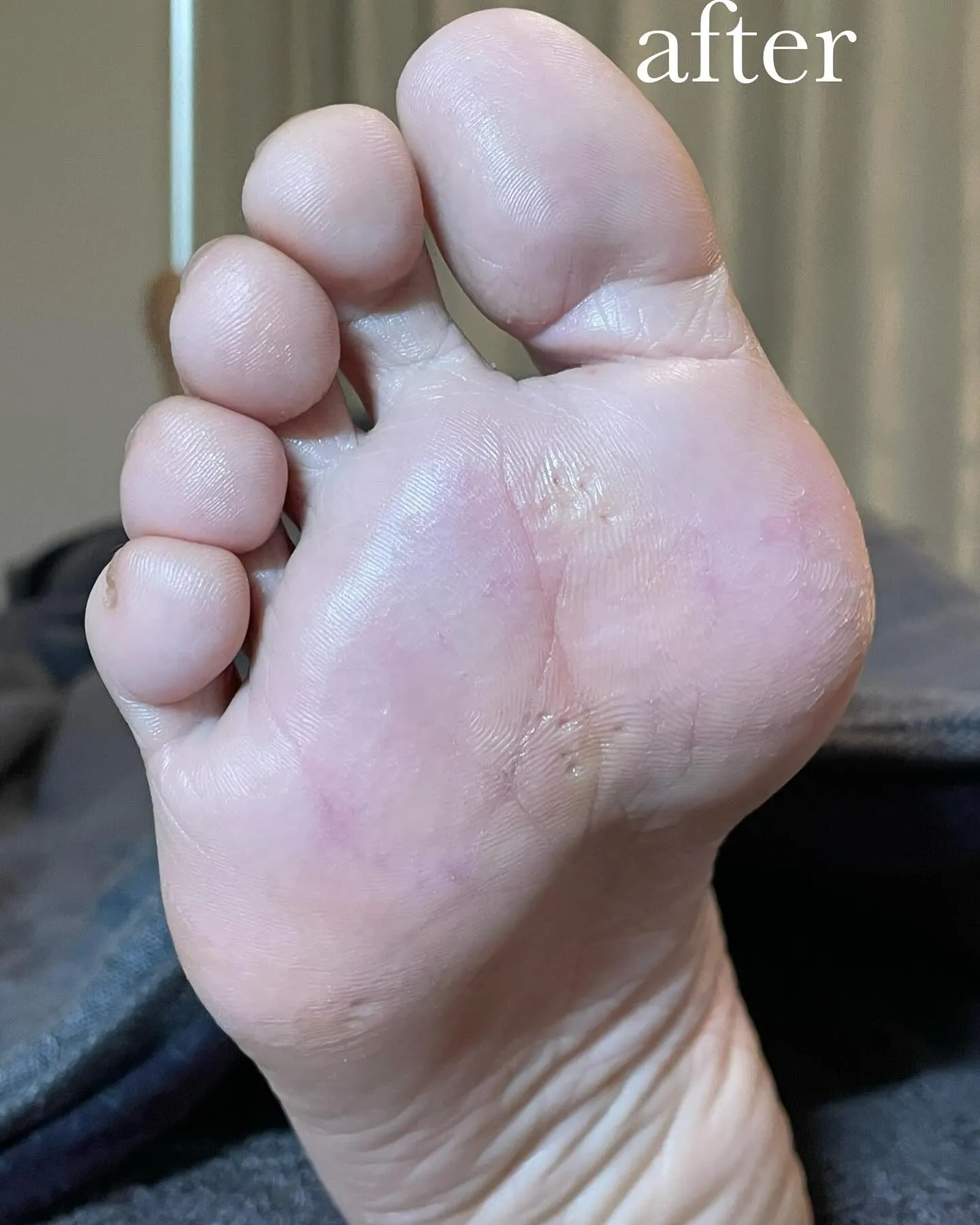 もうすぐサンダルを履く…キレイな素足でいたい!右足編☆