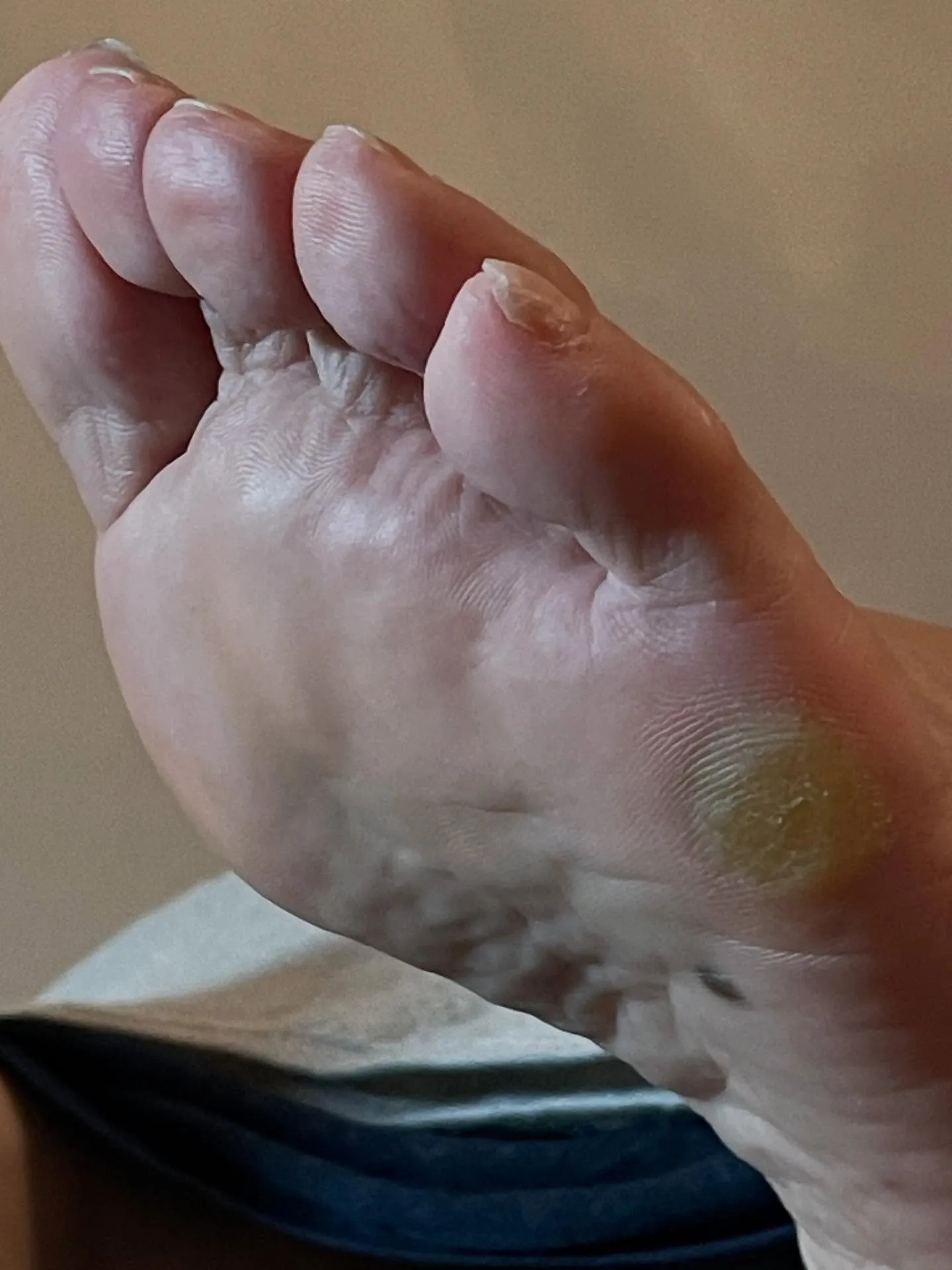 “小指の下のタコ”が解放されるだけで救われる✨姿勢もよくなる...