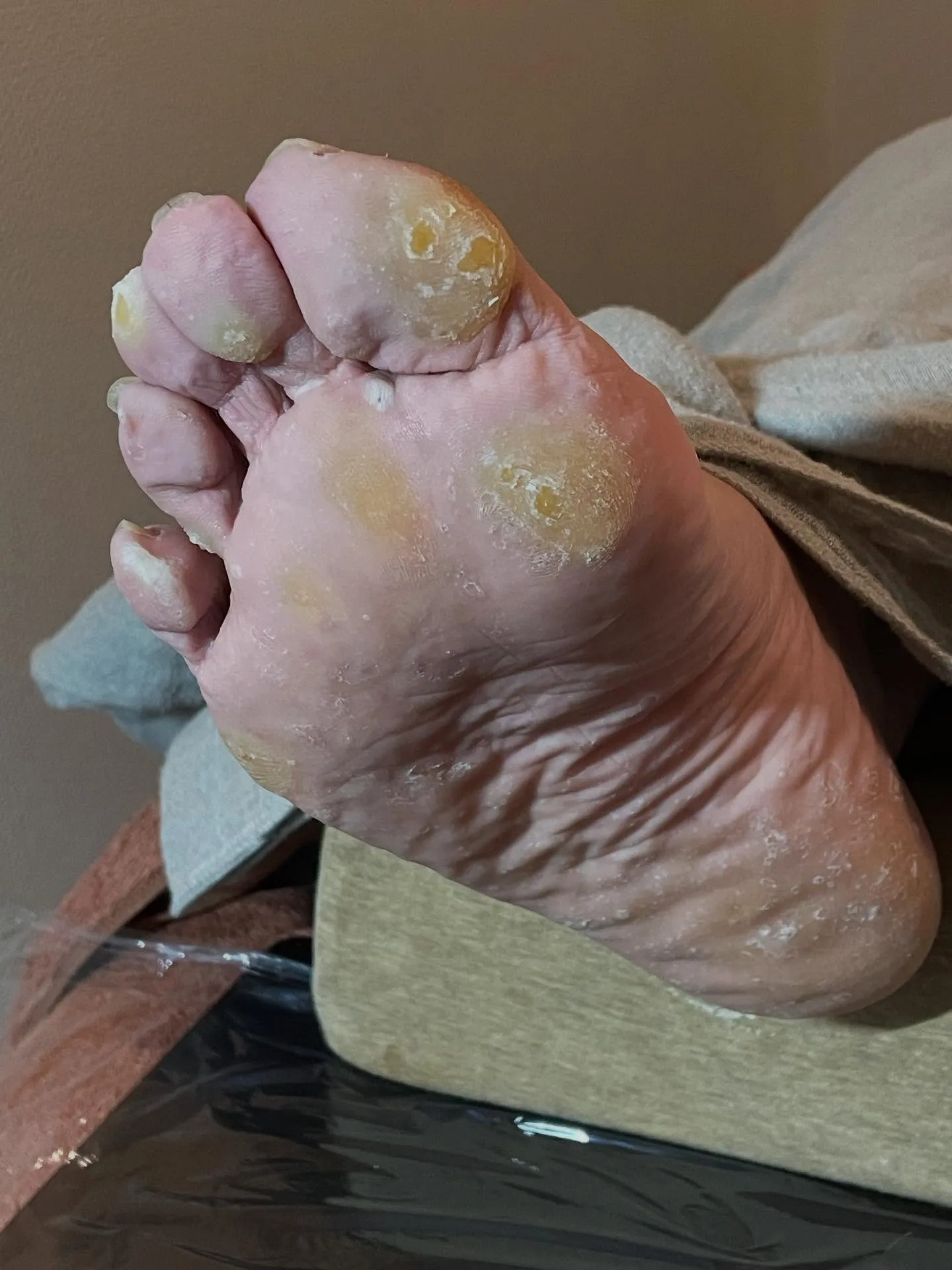 疲れやすいのは足の角質・タコ・魚の目が原因だった⁉️