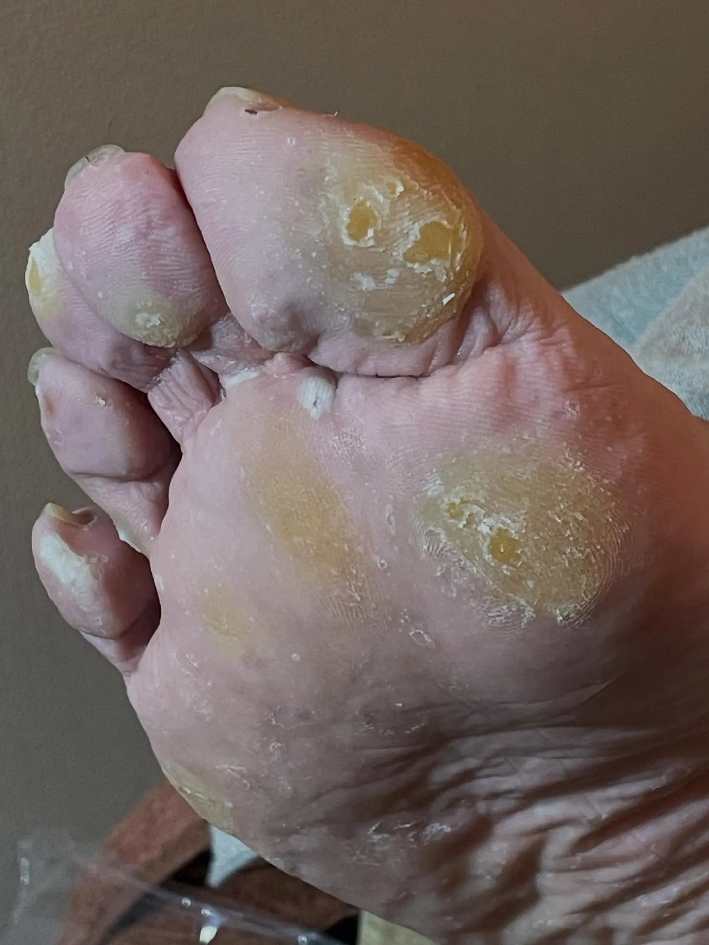 疲れやすいのは足の角質・タコ・魚の目が原因だった⁉️