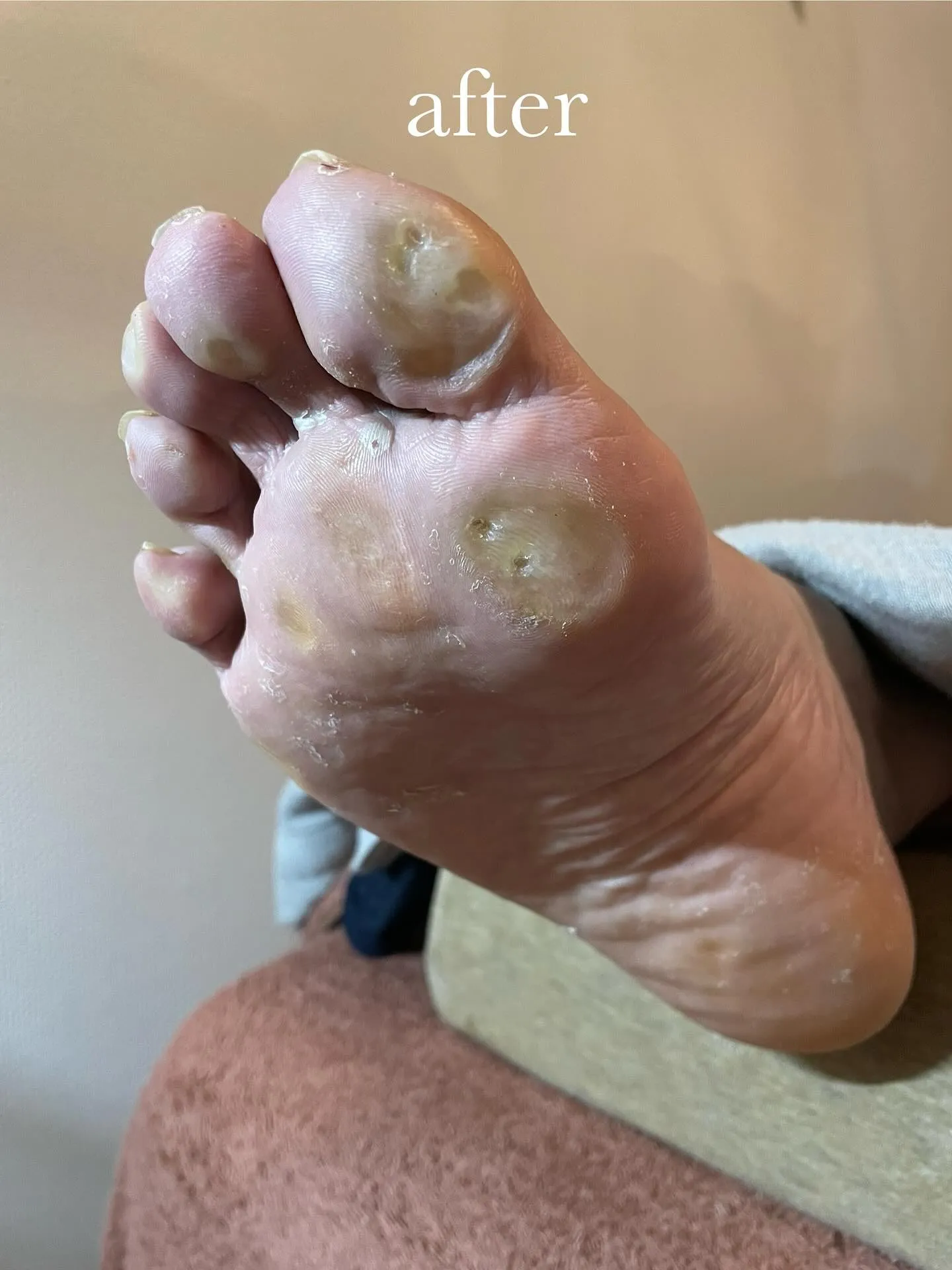 疲れやすいのは足の角質・タコ・魚の目が原因だった⁉️