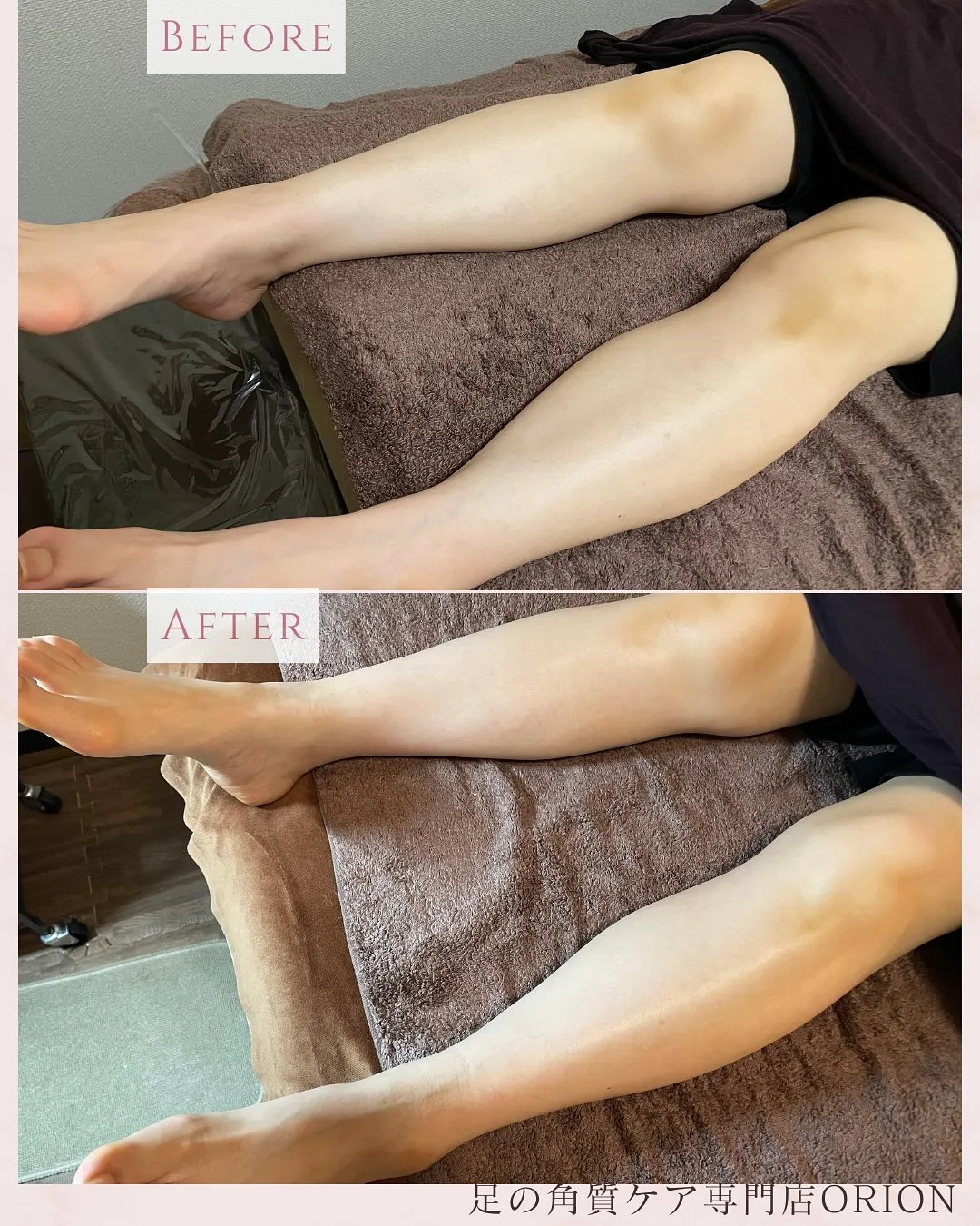 美✨ふくらはぎ❗️角質ケア＆足つぼ90分セットコース◎