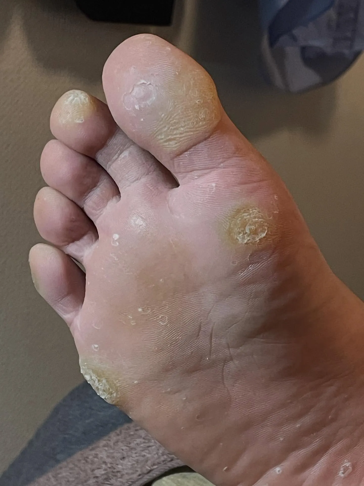 角質ケア＋足つぼ後は快適＆軽やかな足に♪靴カパカパ〜笑