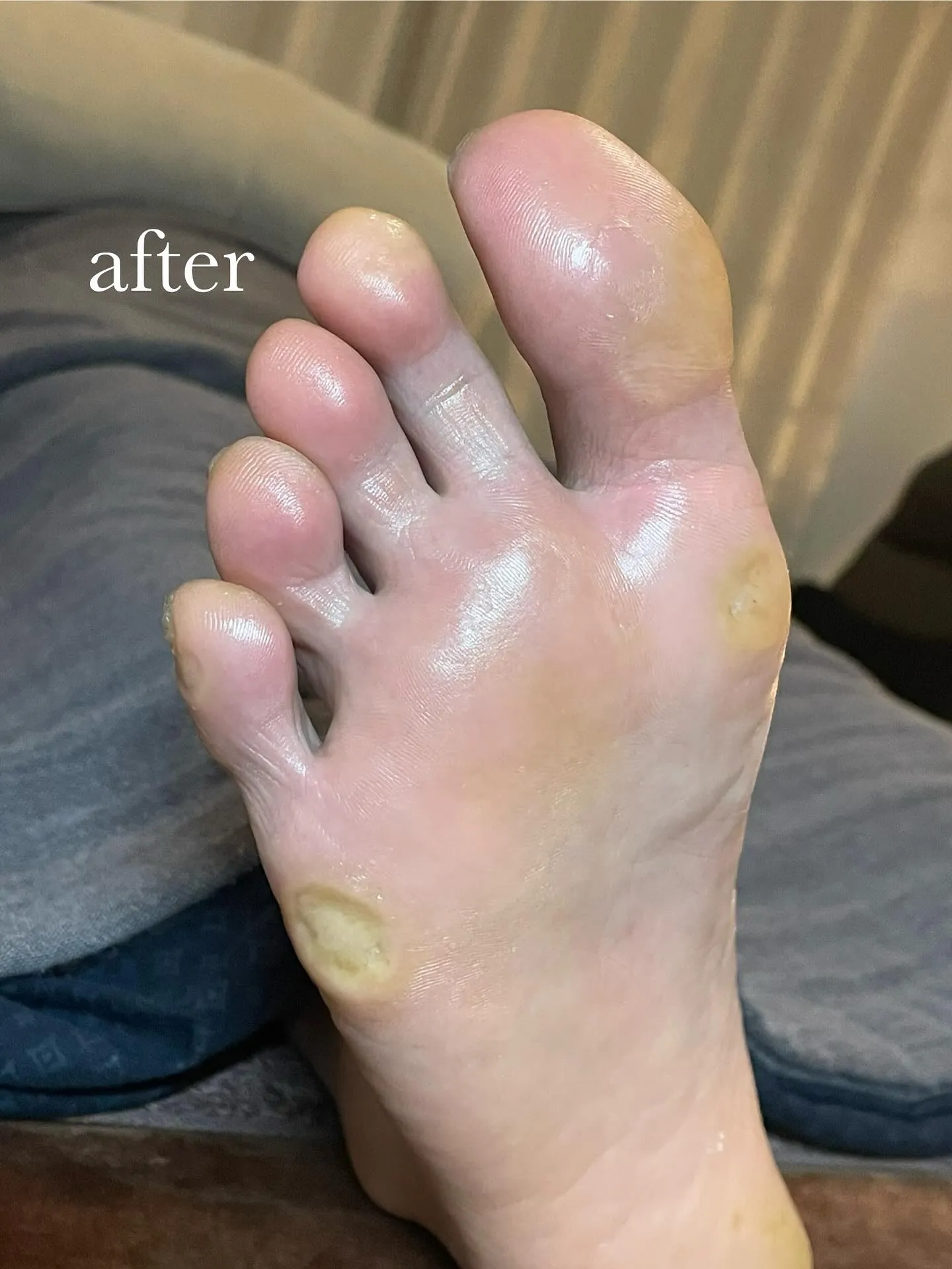 角質ケア＋足つぼ後は快適＆軽やかな足に♪靴カパカパ〜笑
