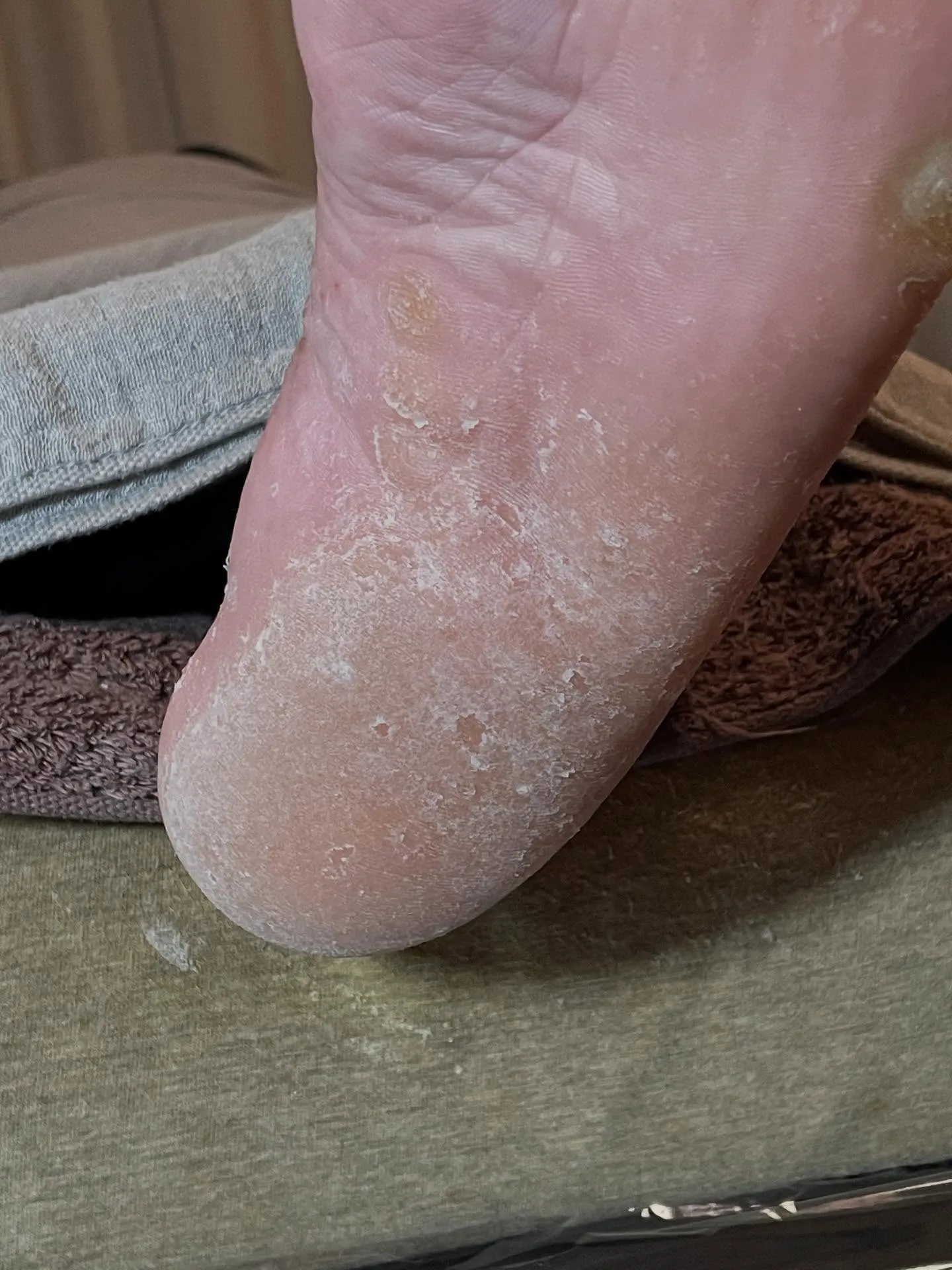 足ストレスは?気になっていた小指下タコ、かかと分厚いの解消❗...