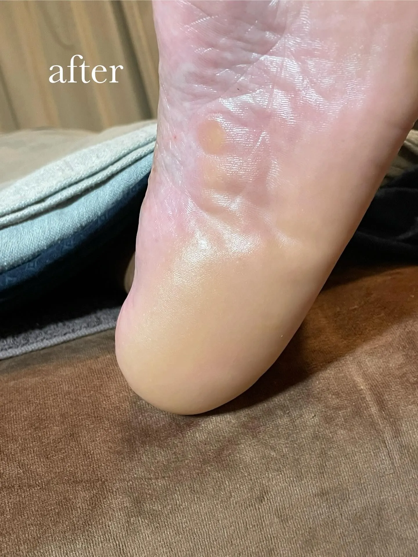 足ストレスは?気になっていた小指下タコ、かかと分厚いの解消❗...