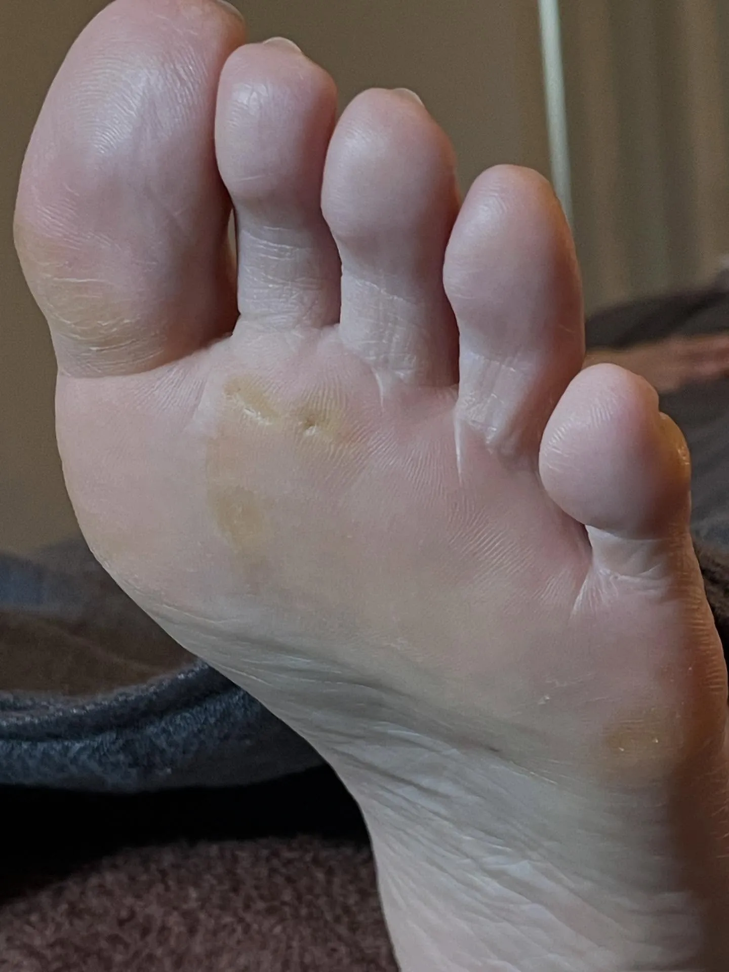 何か違和感!隠れて魚の目が… 真ん中から小指から(ノ_<)