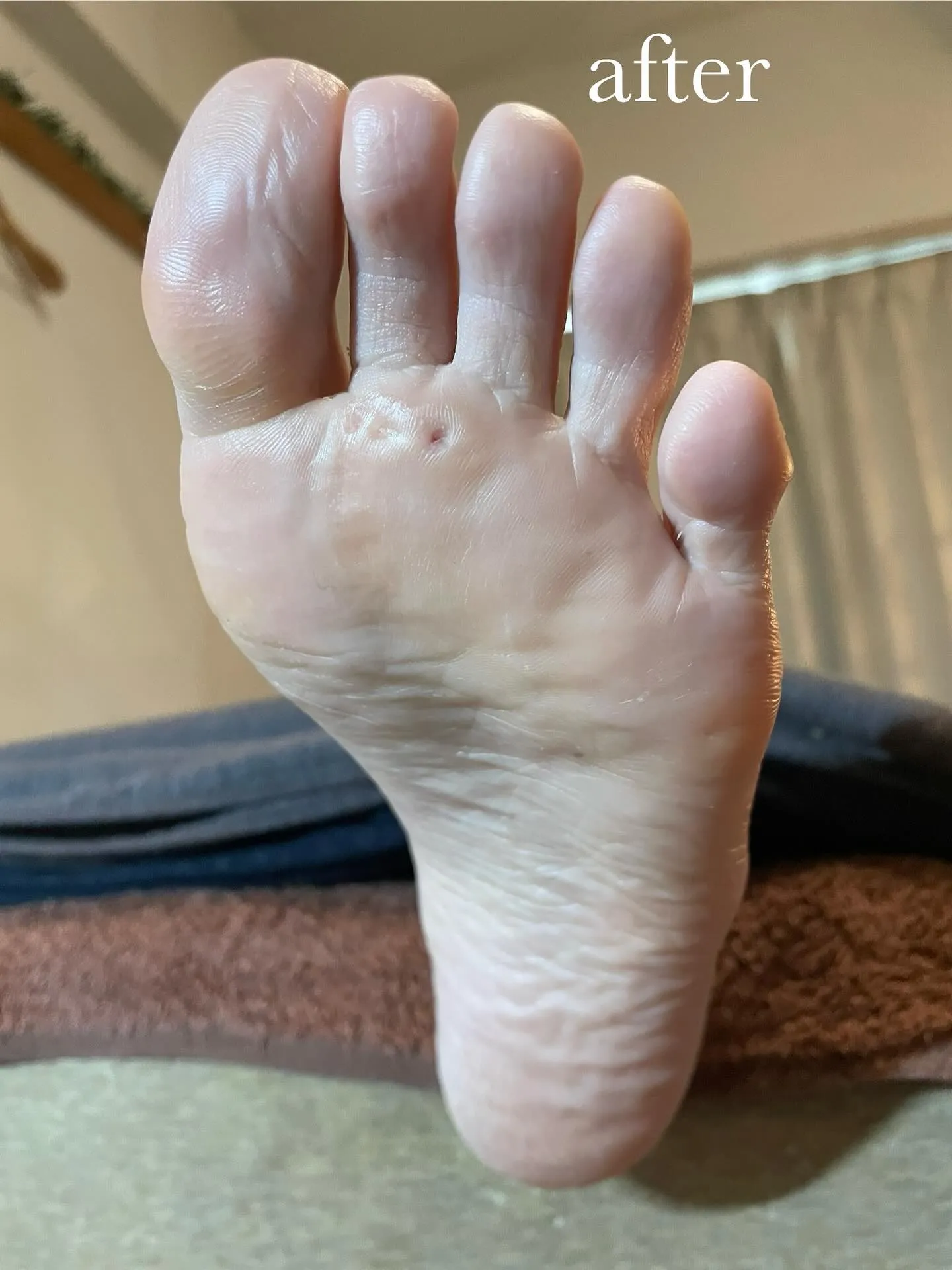 何か違和感!隠れて魚の目が… 真ん中から小指から(ノ_<)