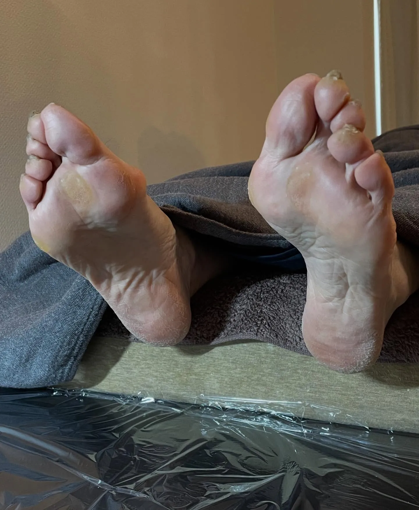 かかとガサガサ…ひんぱんに起こる!靴の中でこすれてるかも∑(...