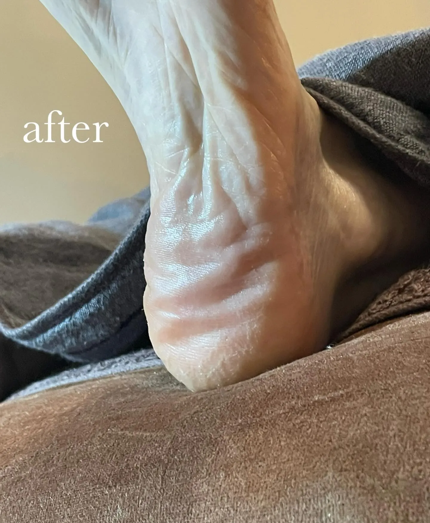 かかとガサガサ…ひんぱんに起こる!靴の中でこすれてるかも∑(...