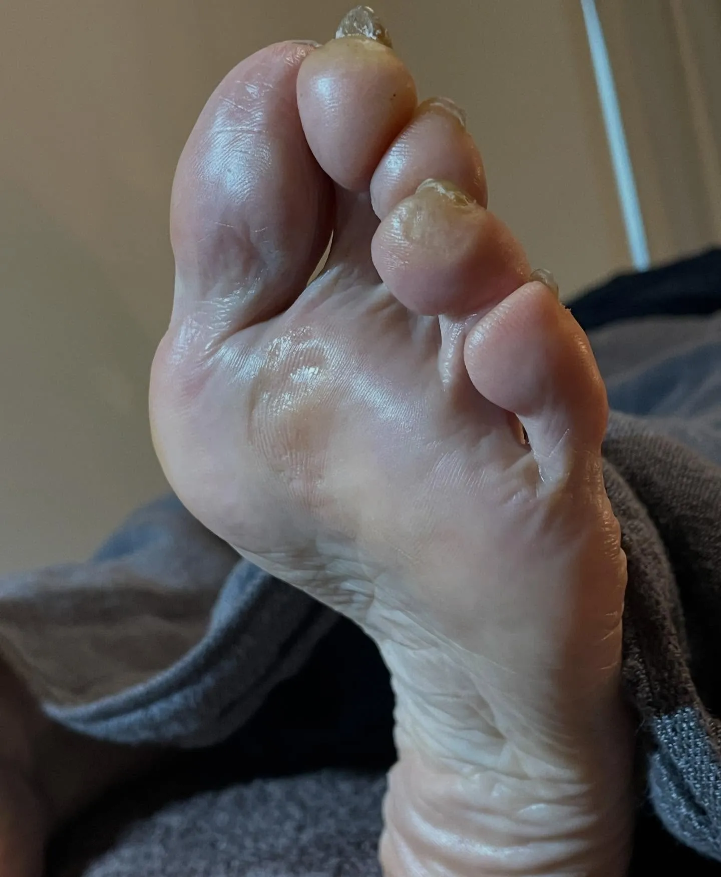 かかとガサガサ…ひんぱんに起こる!靴の中でこすれてるかも∑(...