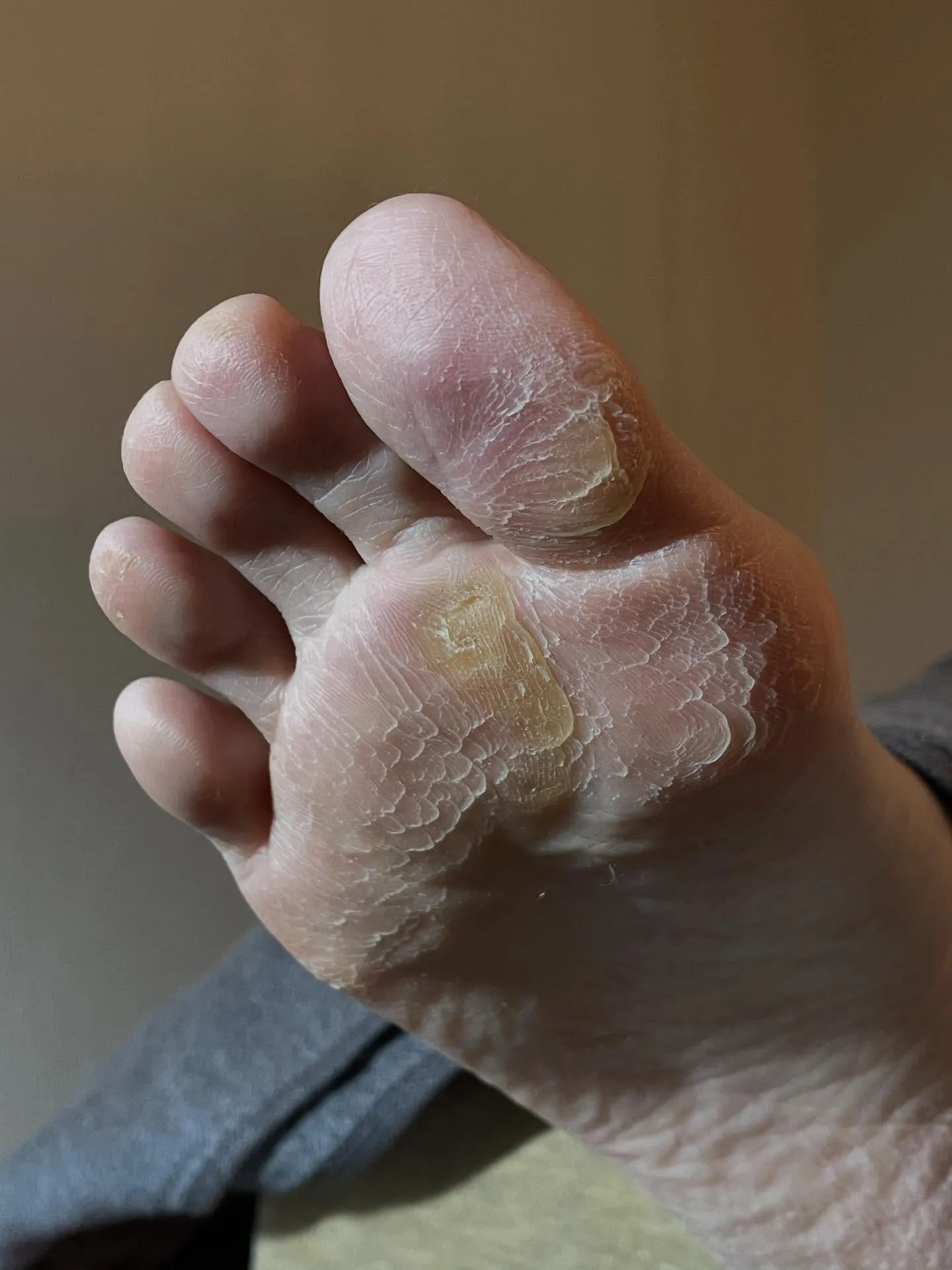 急に足が痛くなりました！驚　原因は“ヒールだこ”の放置⁉️