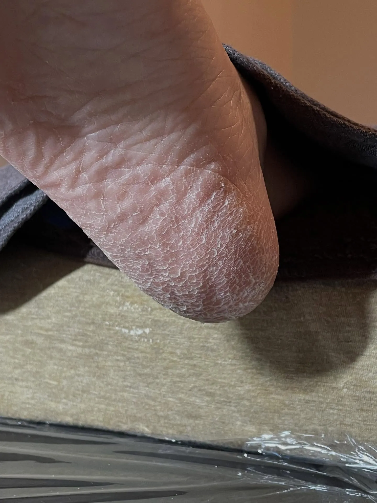 急に足が痛くなりました！驚　原因は“ヒールだこ”の放置⁉️