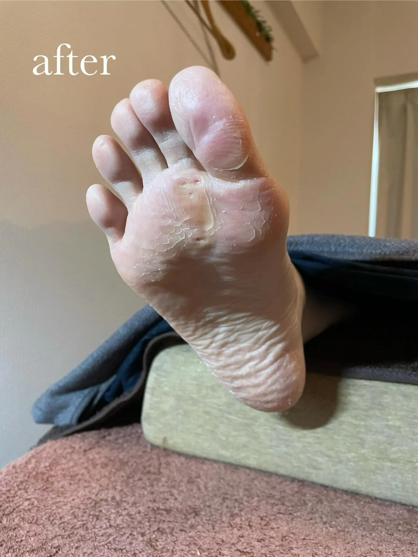 急に足が痛くなりました！驚　原因は“ヒールだこ”の放置⁉️