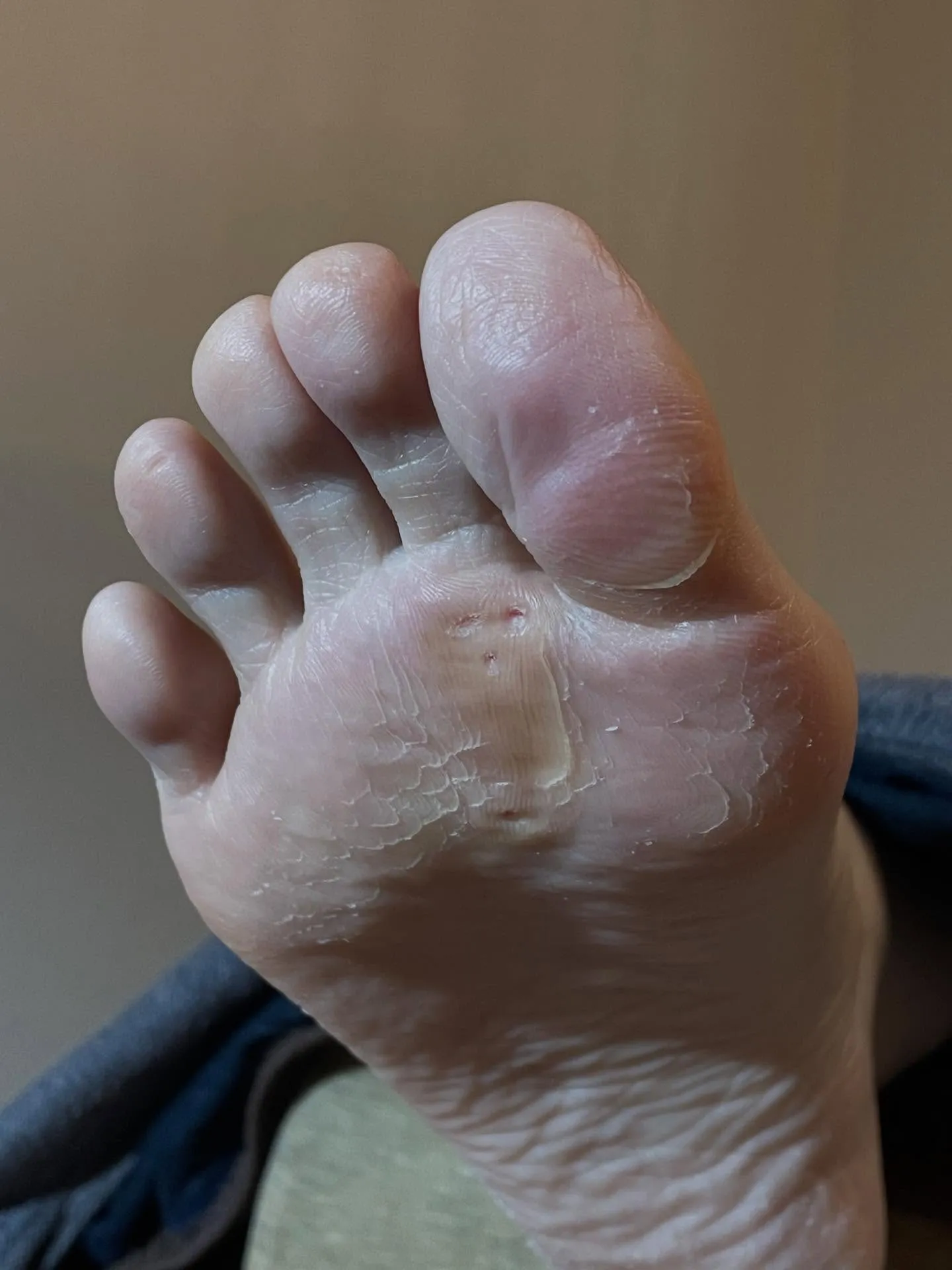 急に足が痛くなりました！驚　原因は“ヒールだこ”の放置⁉️