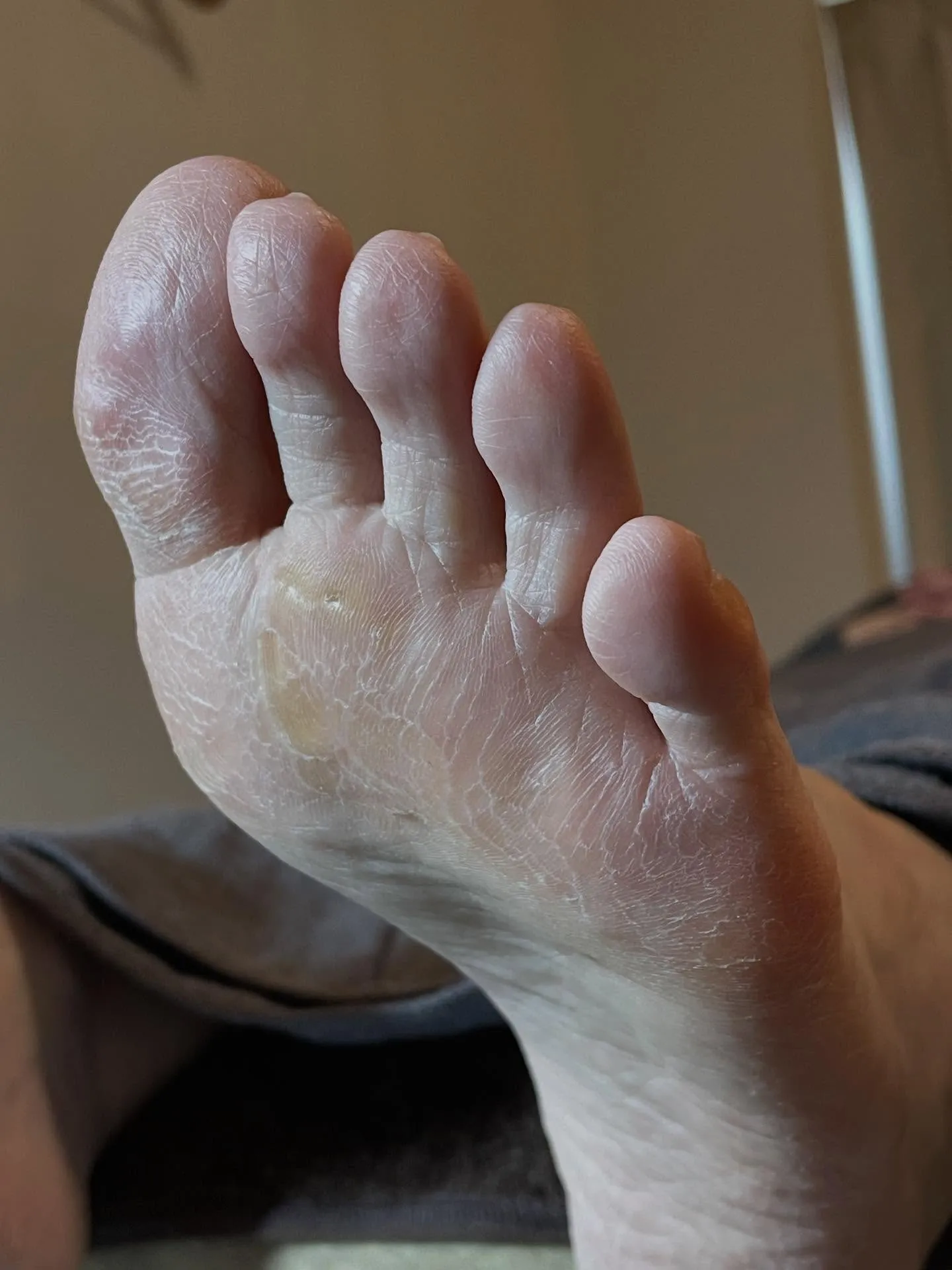 「かかとに魚の目が…」本人もまさかそんな所にあるなんて(驚)