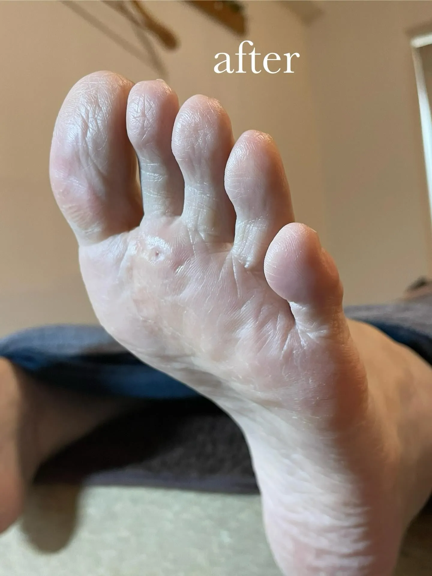 「かかとに魚の目が…」本人もまさかそんな所にあるなんて(驚)