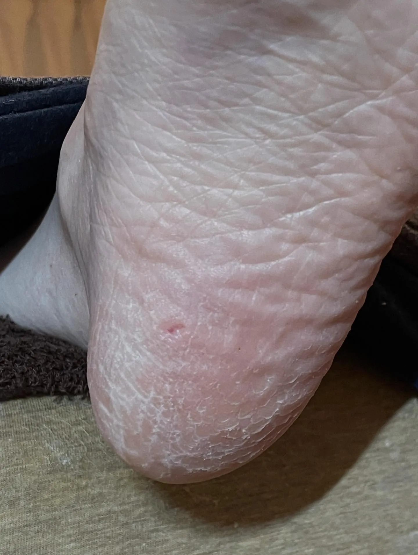 「かかとに魚の目が…」本人もまさかそんな所にあるなんて(驚)