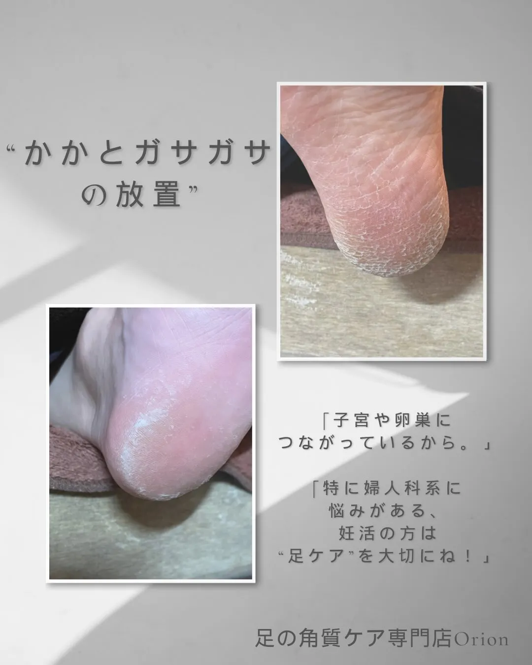 “かかとガサガサ”の放置はやめて良かった〜ッ♪大切な所と繋が...
