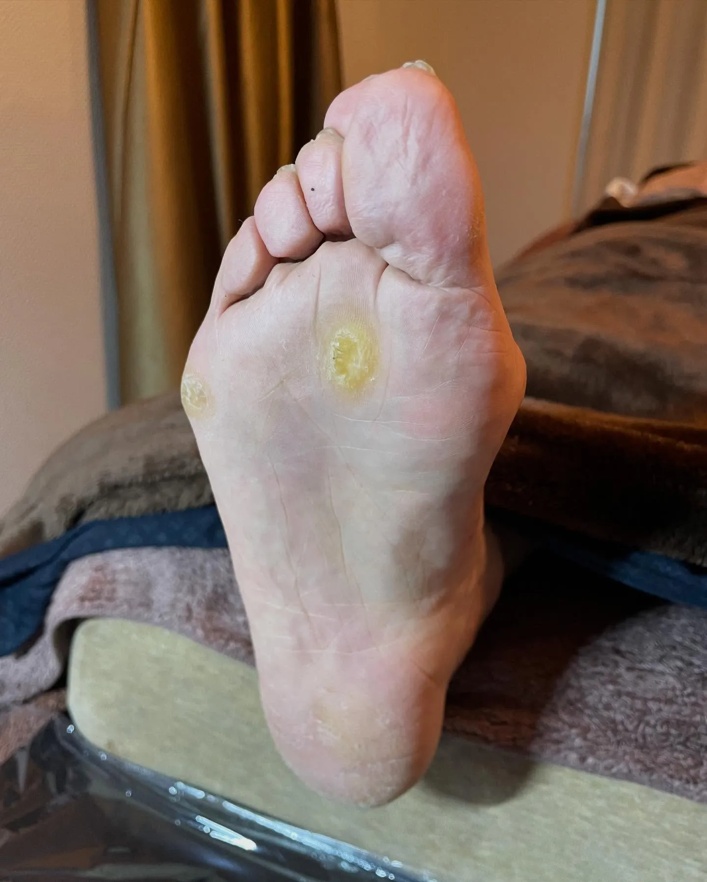 長年の悩みだった足裏の大きいタコ、かかとガサガサも…