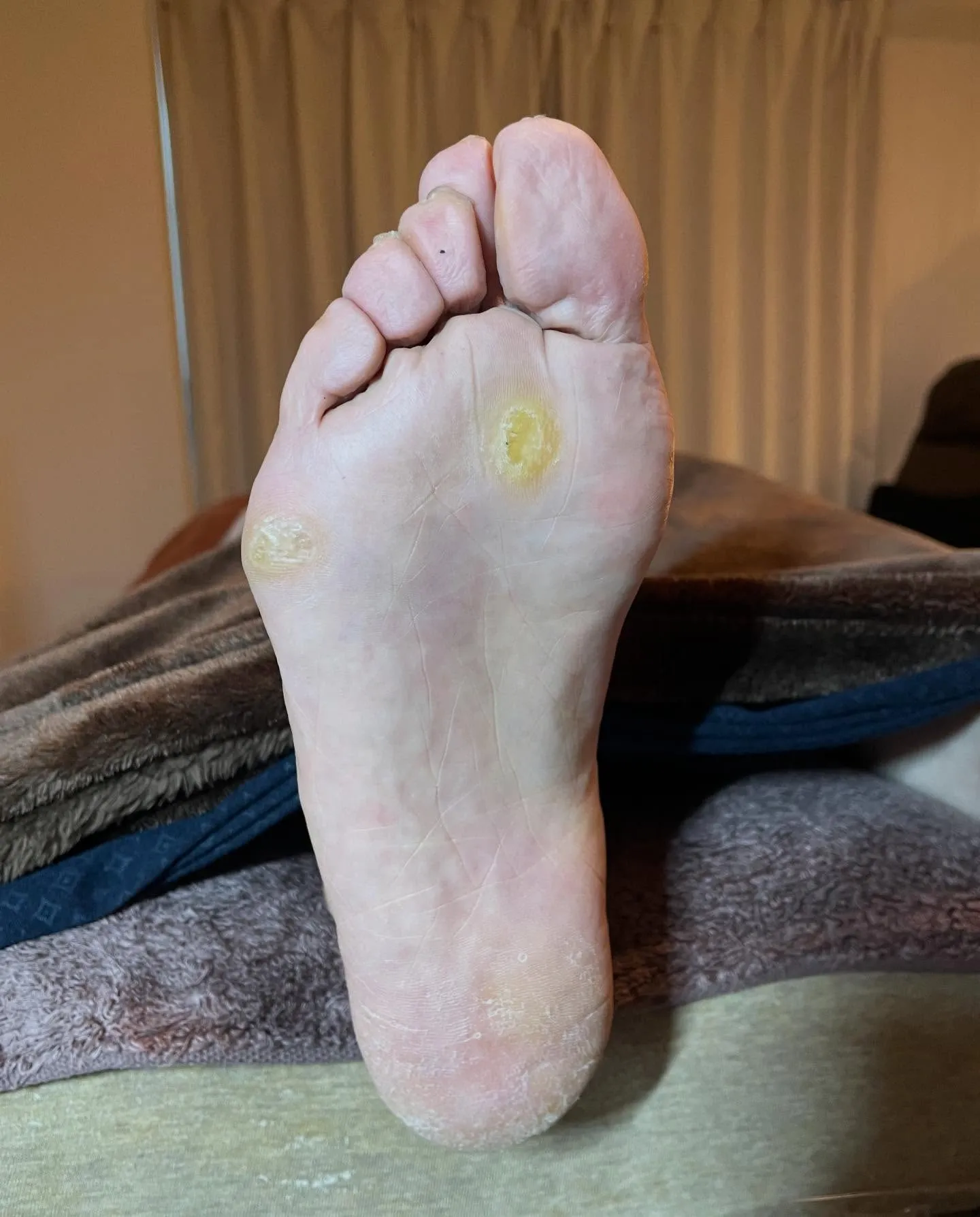 長年の悩みだった足裏の大きいタコ、かかとガサガサも…