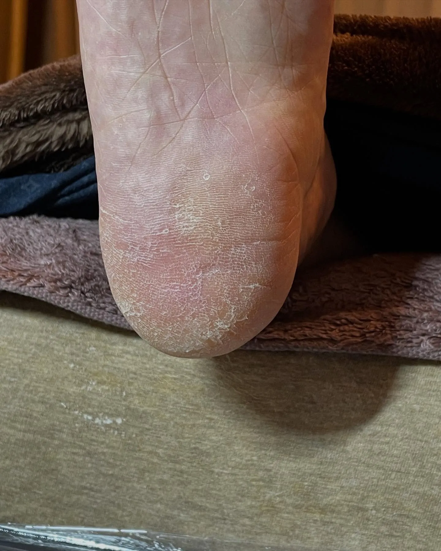 長年の悩みだった足裏の大きいタコ、かかとガサガサも…