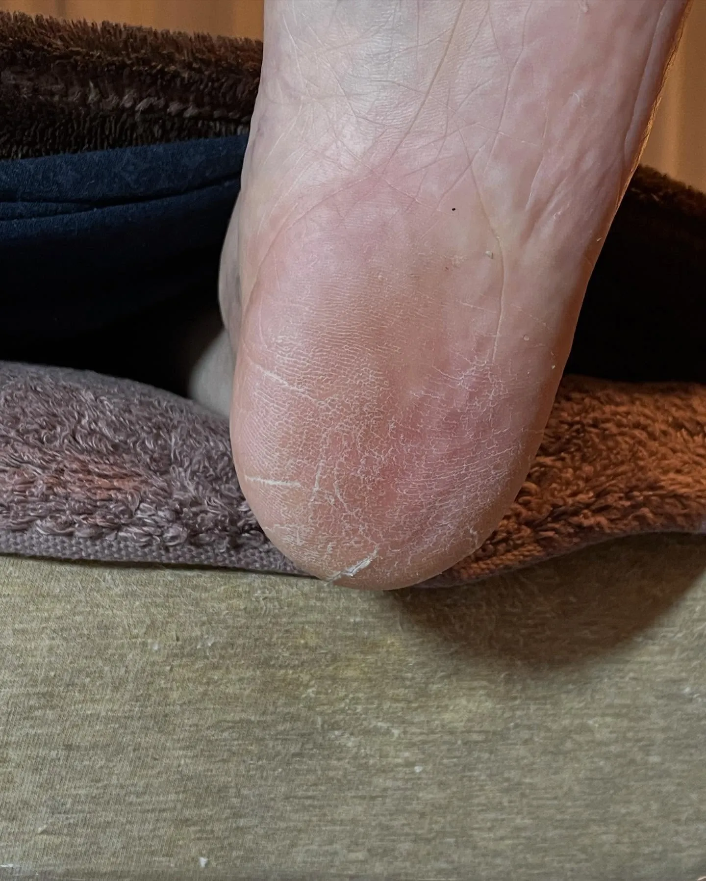 長年の悩みだった足裏の大きいタコ、かかとガサガサも…