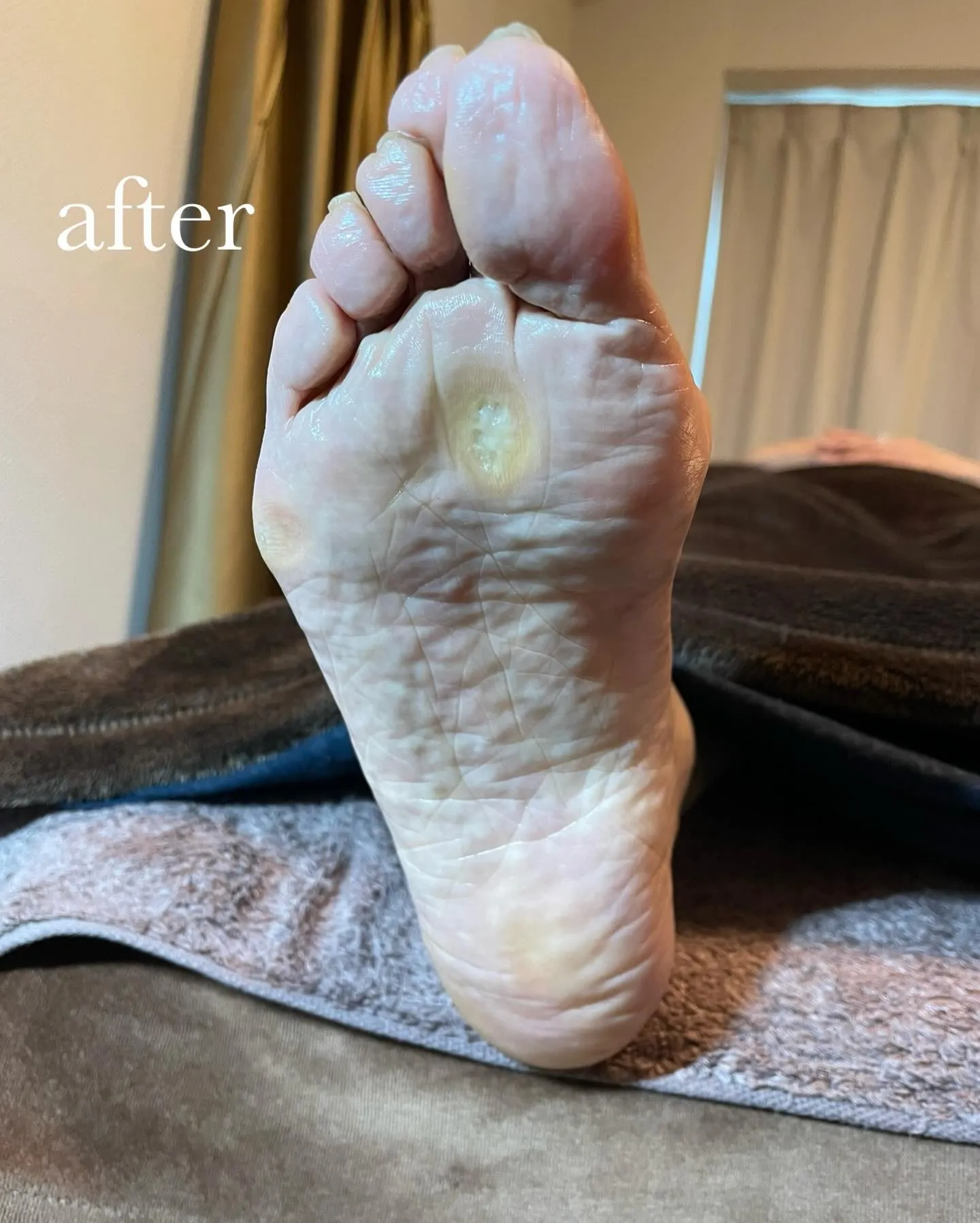 長年の悩みだった足裏の大きいタコ、かかとガサガサも…