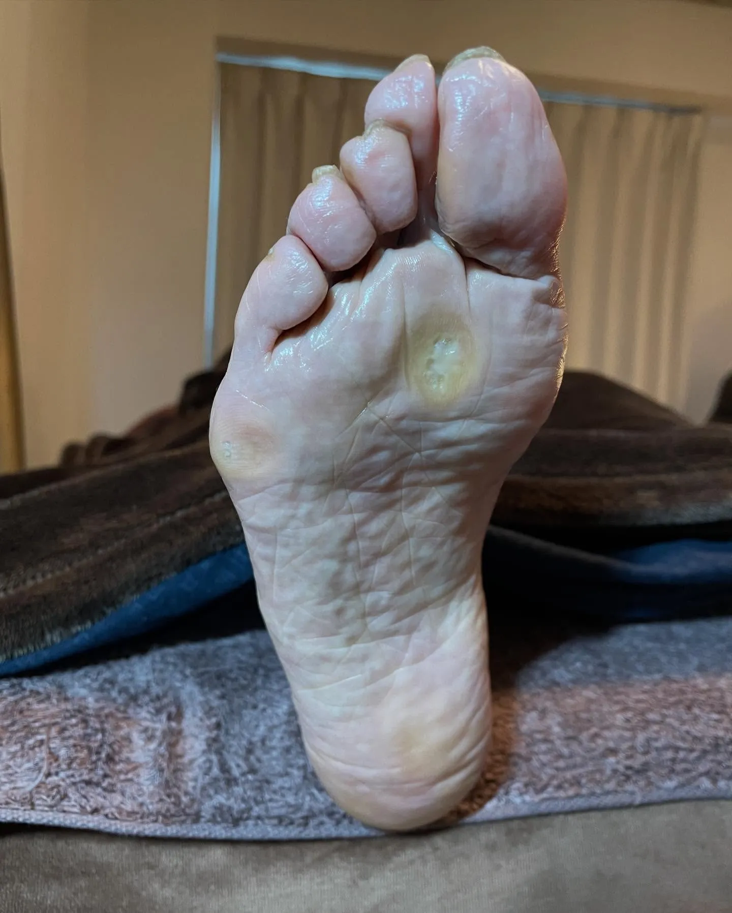 長年の悩みだった足裏の大きいタコ、かかとガサガサも…