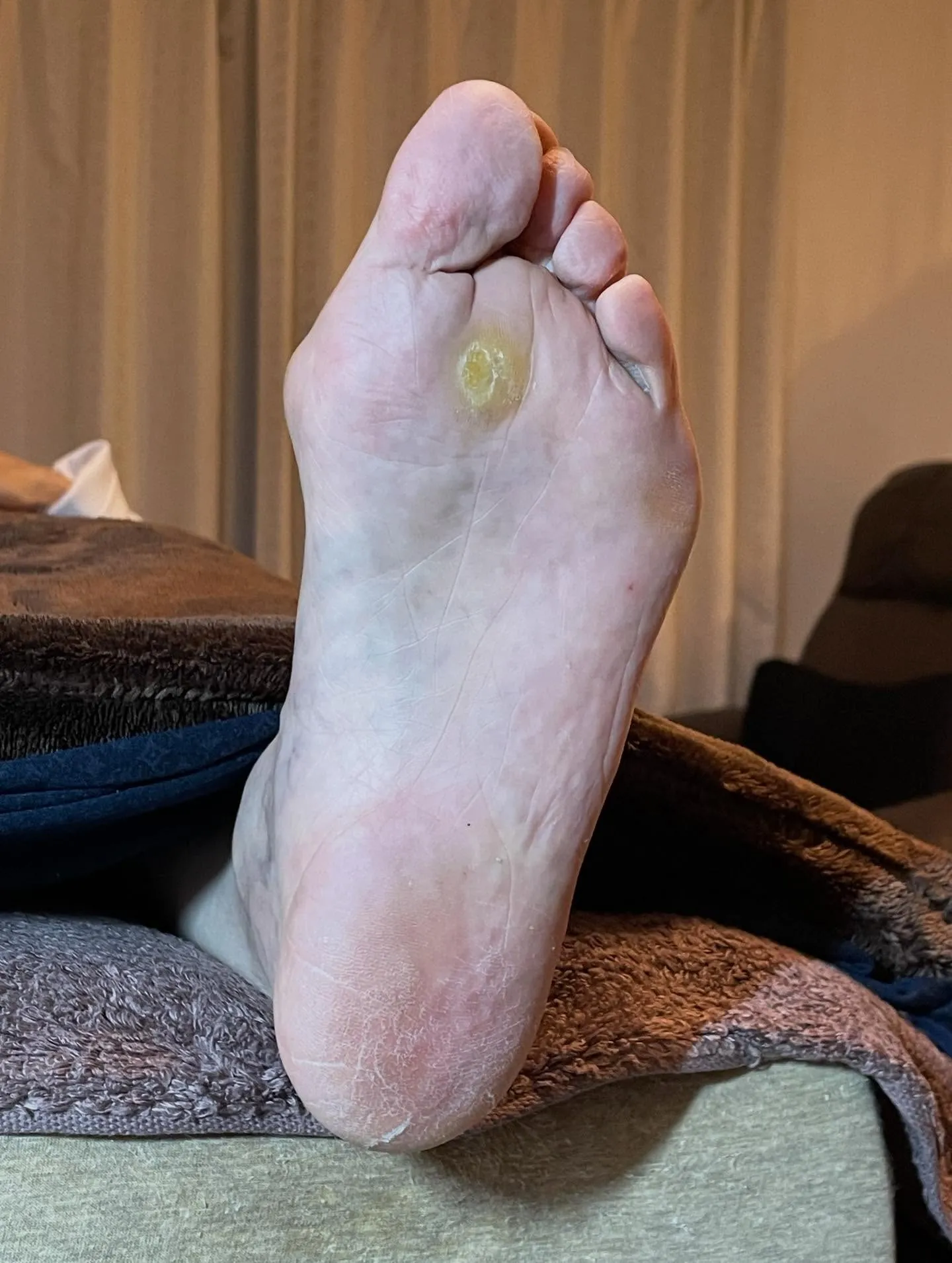 大きな痛かったタコがなくなり靴履くのが楽しみに！♪