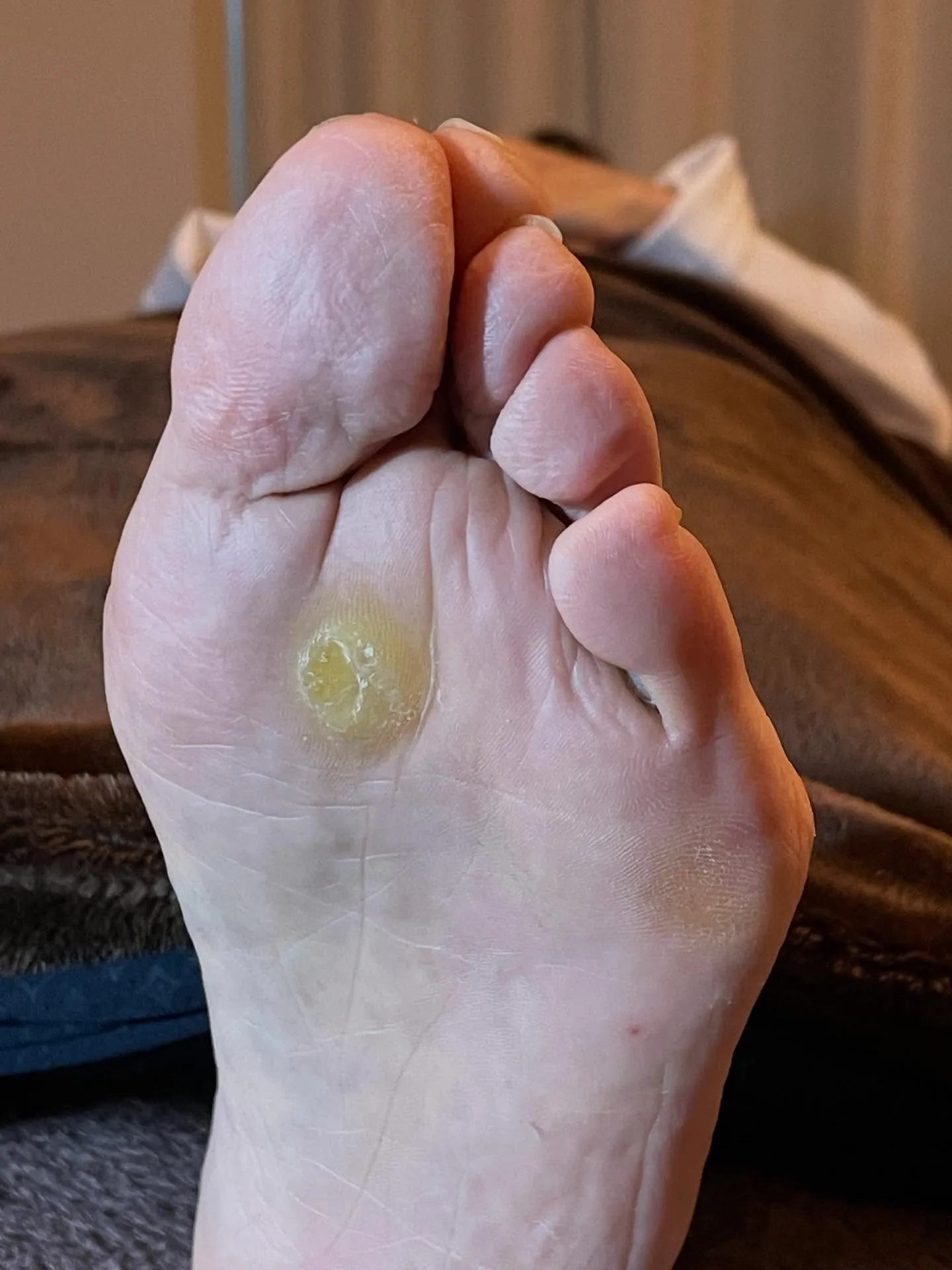 大きな痛かったタコがなくなり靴履くのが楽しみに！♪