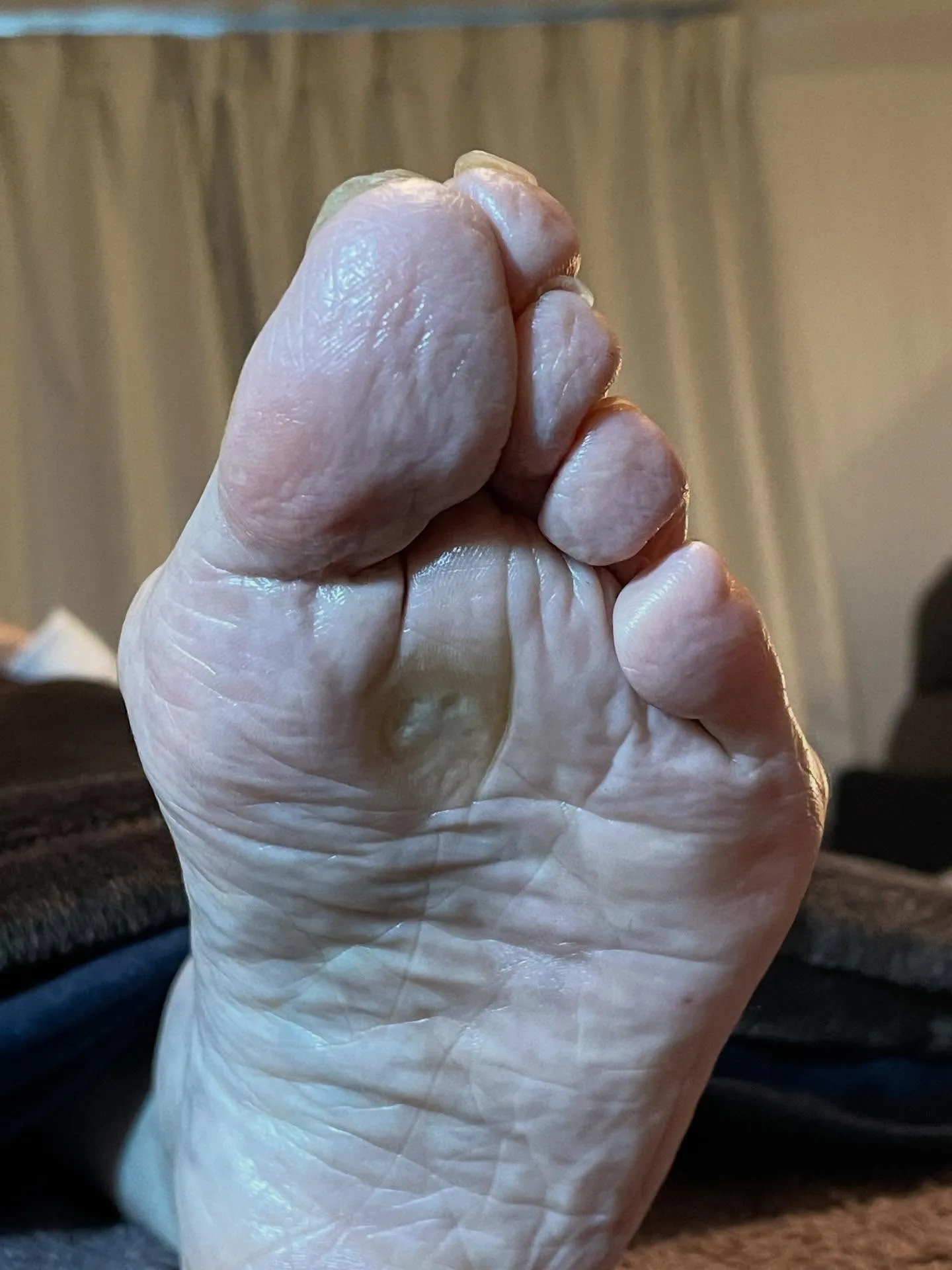 大きな痛かったタコがなくなり靴履くのが楽しみに！♪