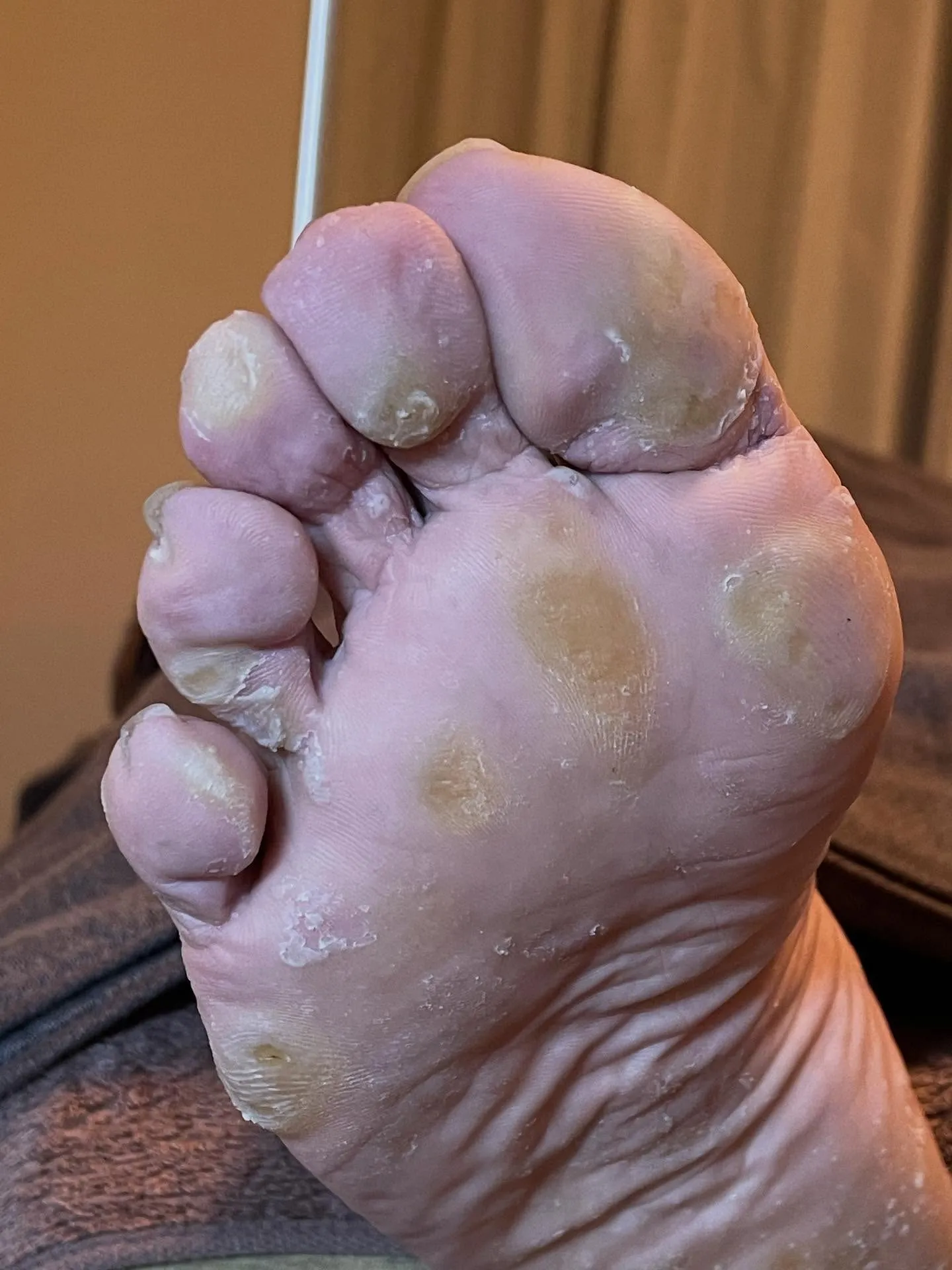 「タコがどうしても痛くて自分で削った…。