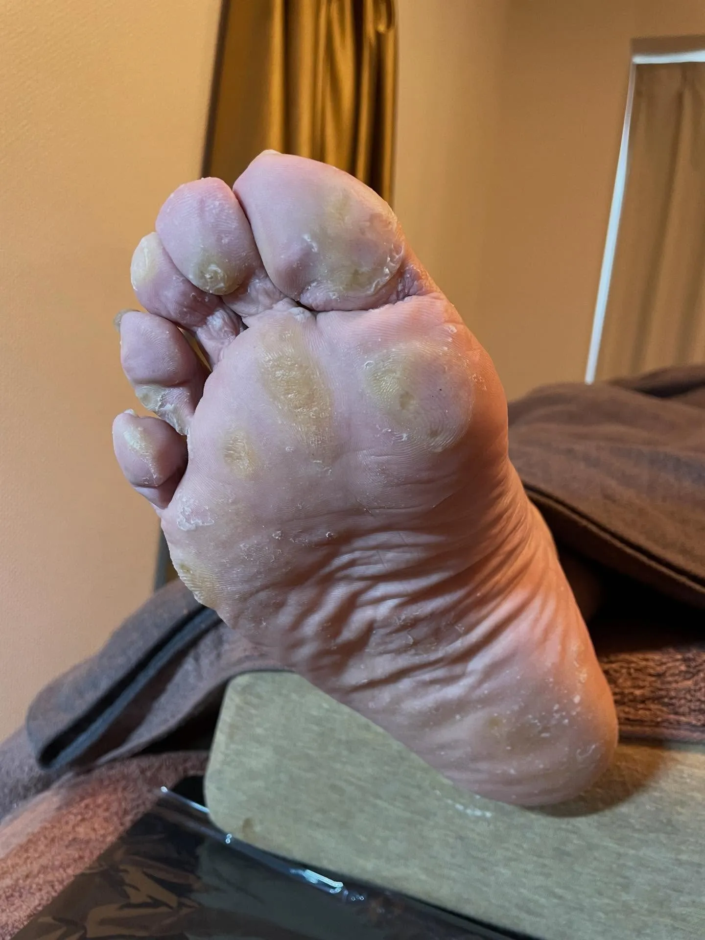 「タコがどうしても痛くて自分で削った…。