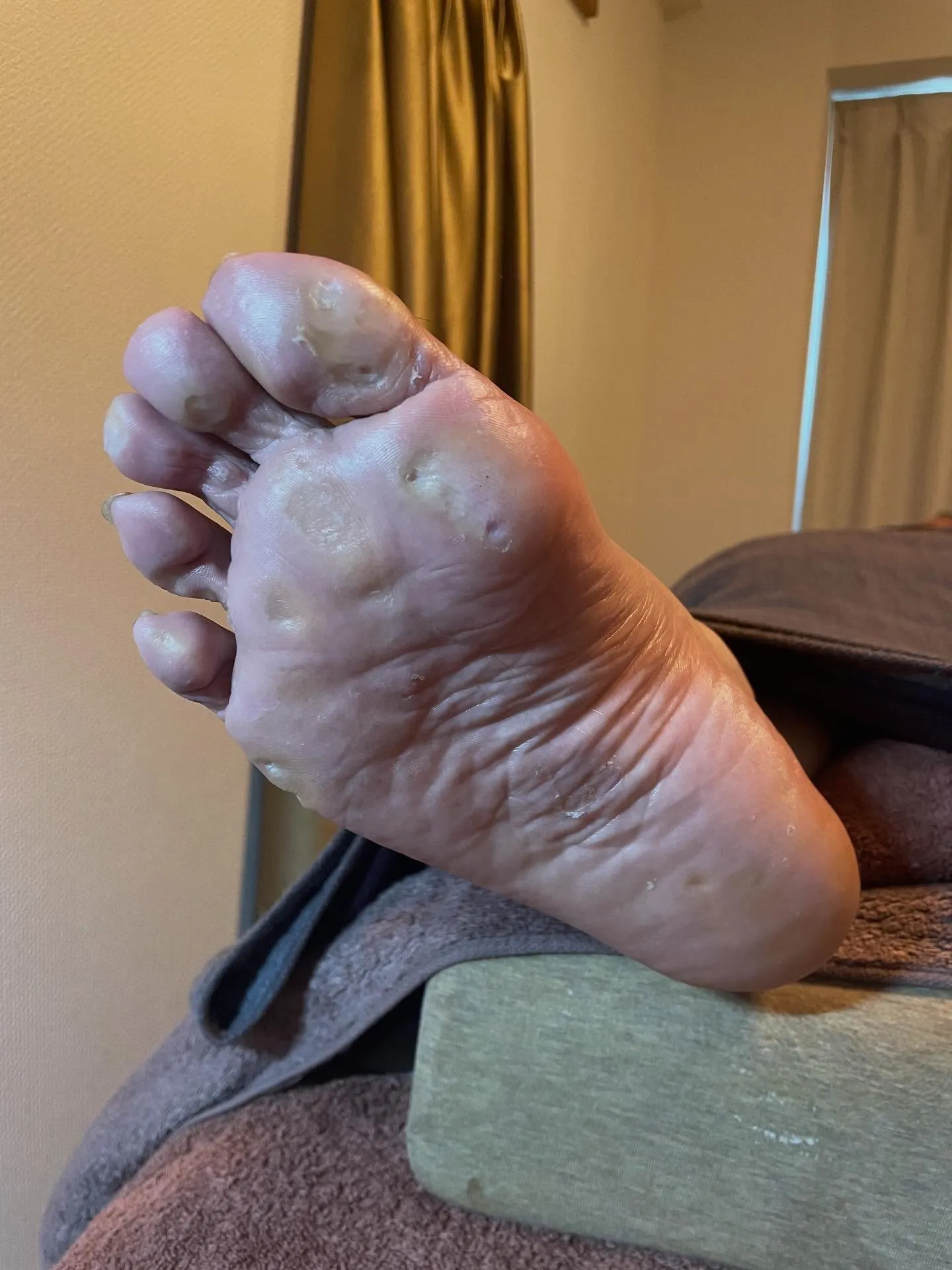 「タコがどうしても痛くて自分で削った…。