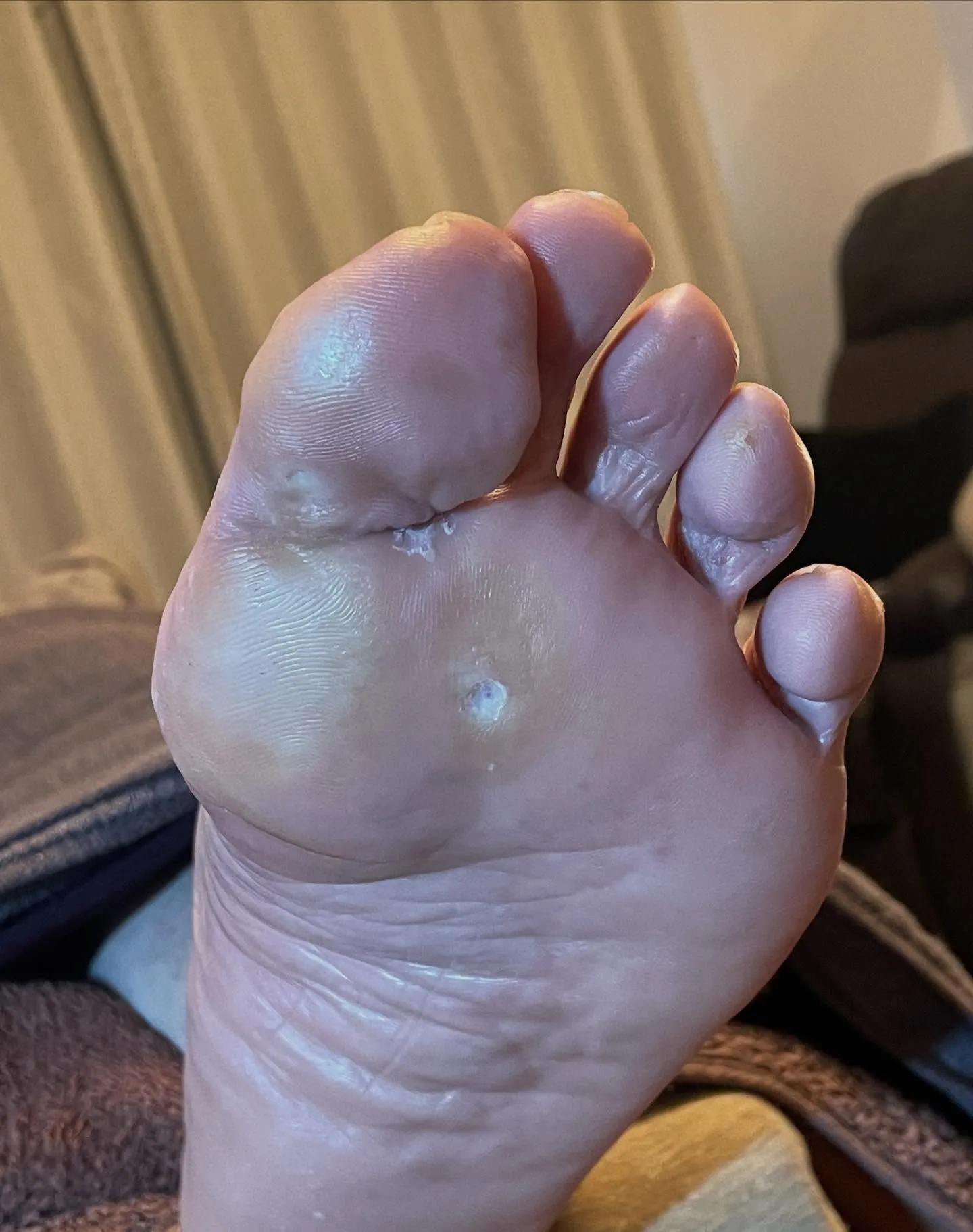 自分でタコ削ったけど、まだ痛い…。