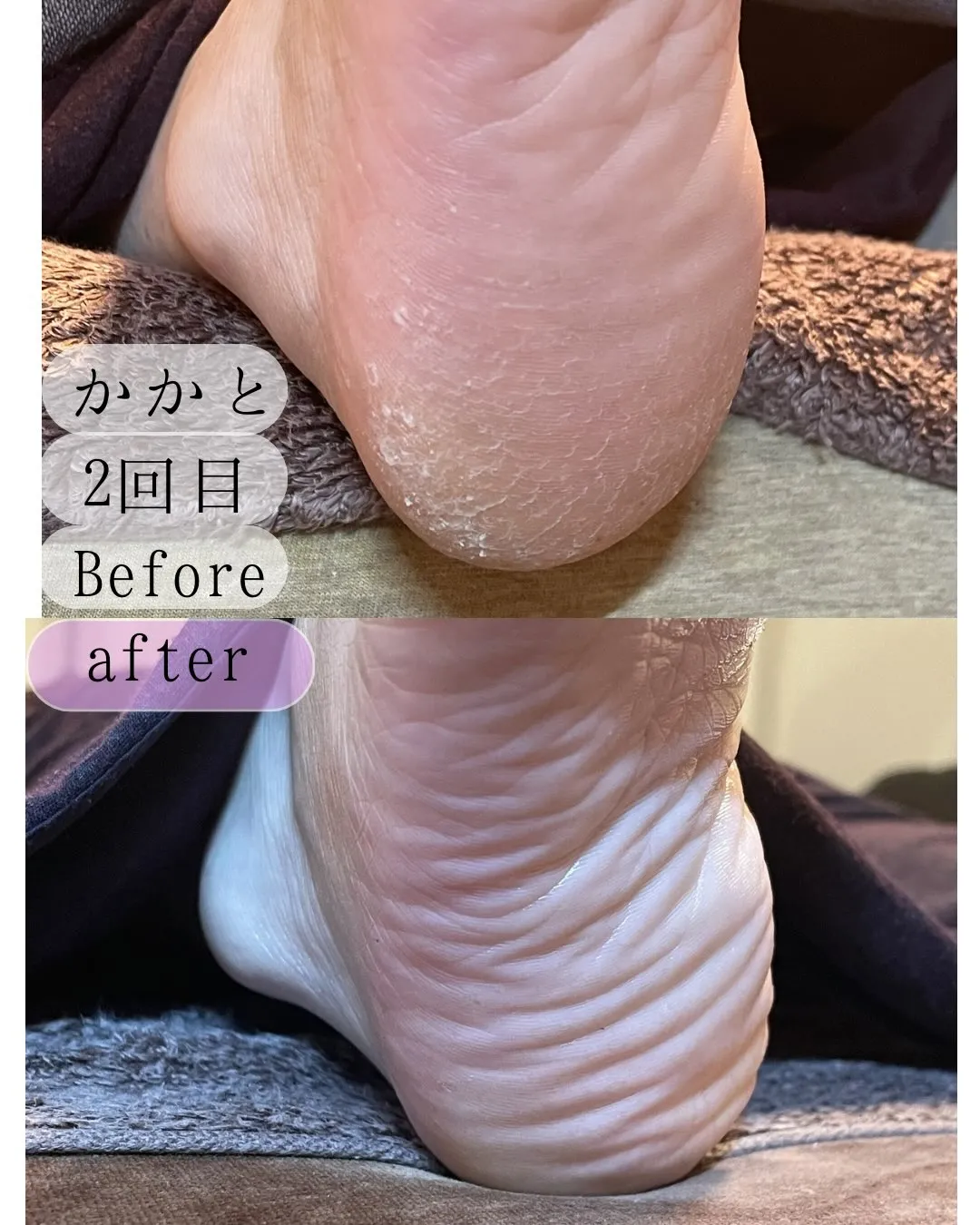 2回目の角質ケア後は違う♪ガサガサ踵からカサカサ踵へ
