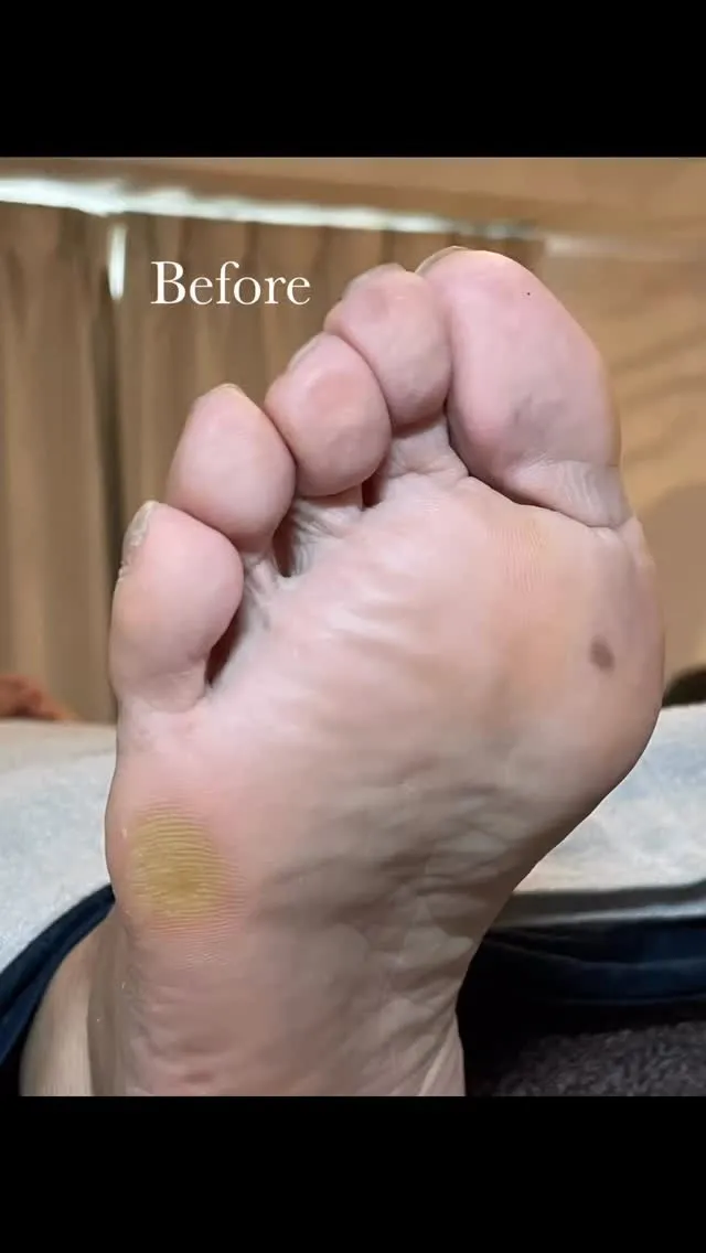 頑張り屋さん、肩こり慢性化さんに多い“小指の下のタコ”